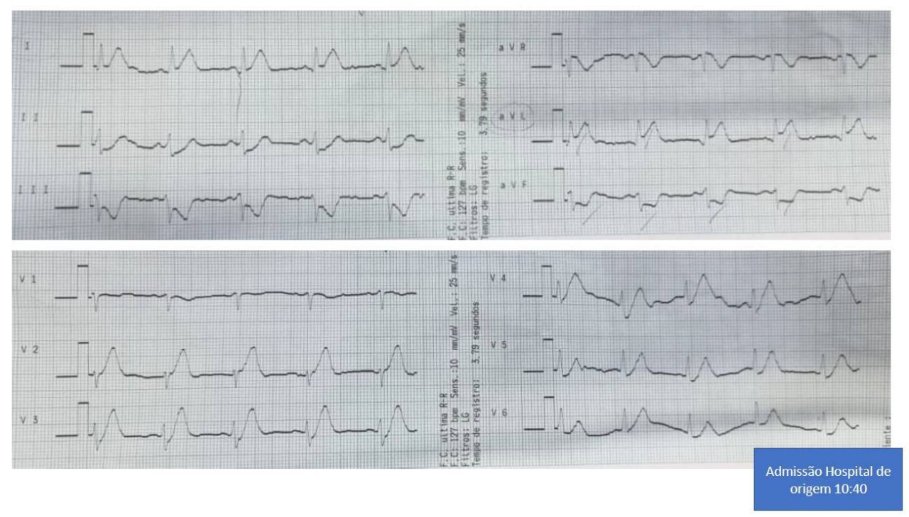 Mujer de 52 años, hpertensa y obesa que presenta episodio de ángor de aparición subita que se continúa con angor progresivo, con presencia de patrón de Winter, siendo tratada con tromboliticos y que desarrolla un RIVA y signos de reperfusión incompleta
