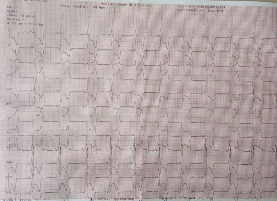 Niño de 14 años con palpitaciones, portador de miocardiopatía hipertrófica no obstructiva y vía accesoria ántero lateral derecha, que desarrolla episodios de FA preexcitada