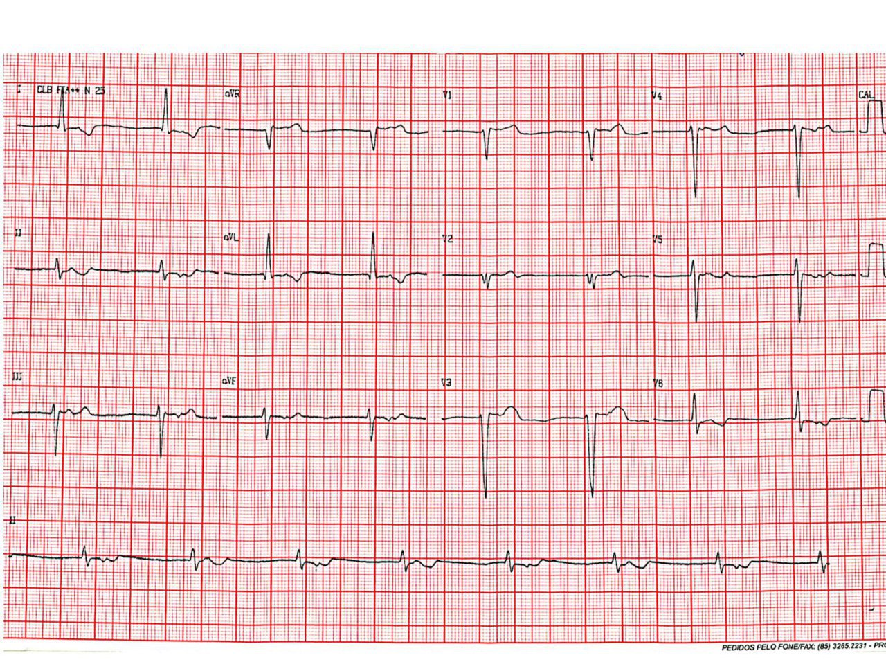 Mujer de 61 años, hipertensa, diabética, en diálisis crónica (trasplante de riñón hace 07 años que evolucionó con disfunción del injerto, volviendo a terapia sustitutiva) e hipotiroidismo, que presenta probable bloqueo sino auricular de tercer grado y disfunción del nódulo sinusal latente