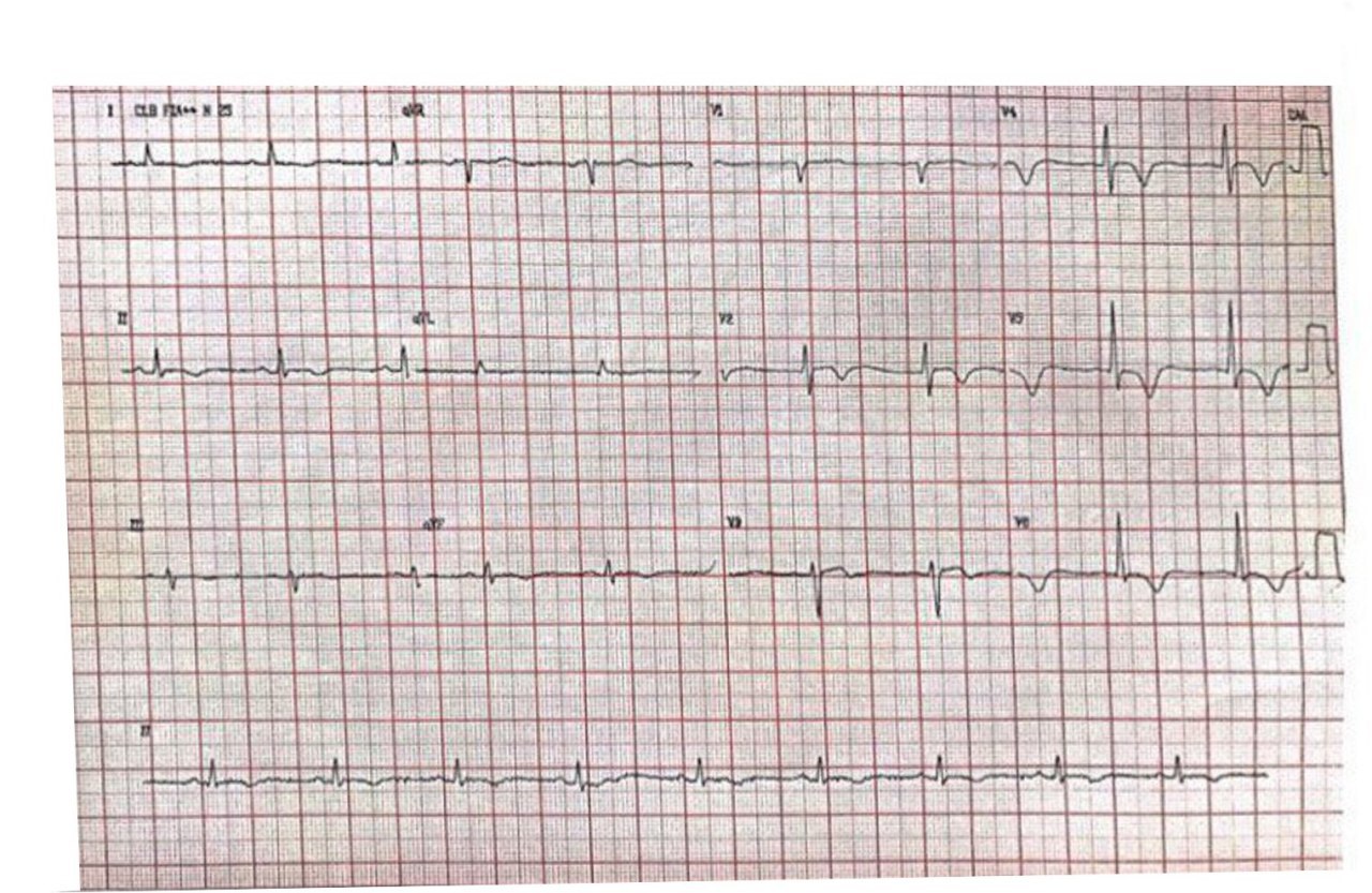 Mujer de 74 años. HTA y DM2 que 10 días antes de la hospitalización presentaba nauseas,vómitos y disnea que cursa con troponina positiva, hipocinesia apical y FEy normal con CCG que pone de manifiesto un síndrome de Takotsubo
