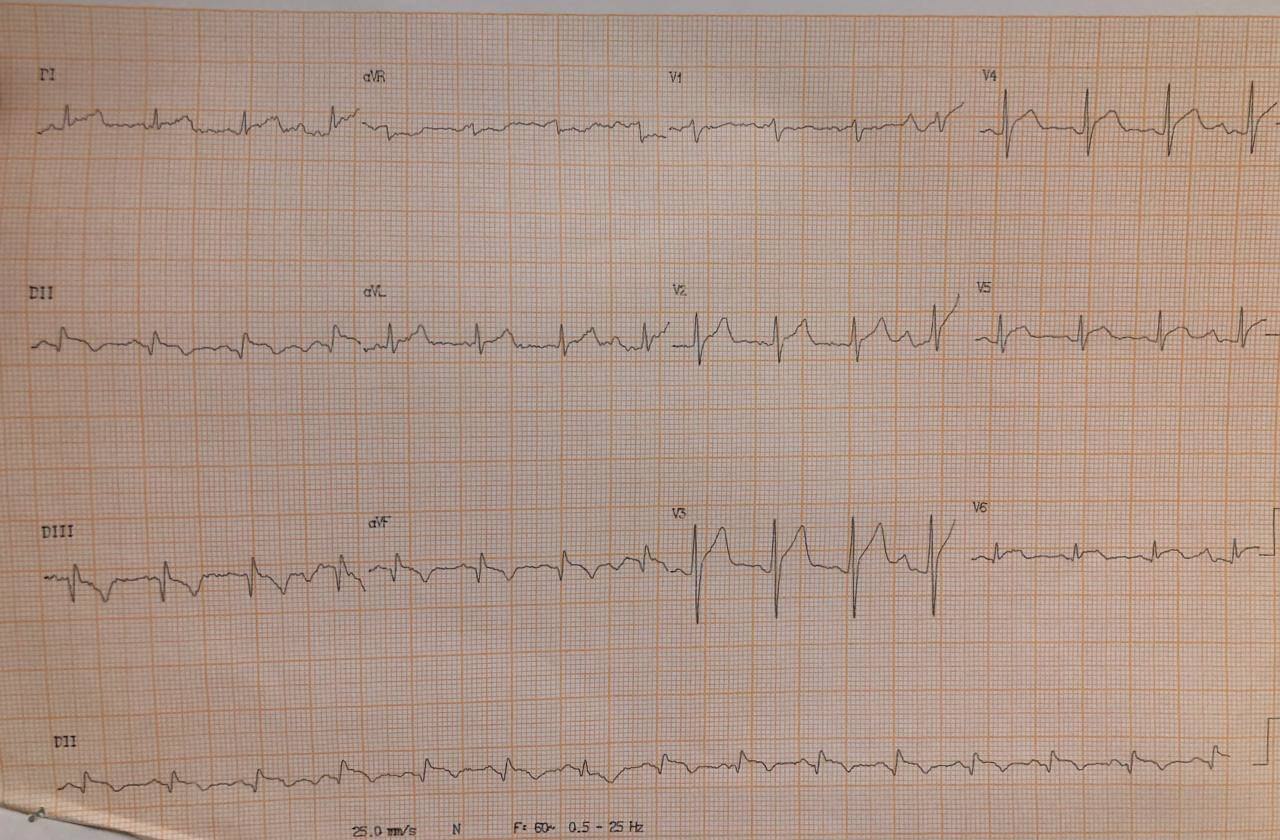 Hombre, 60 años con dolor torácico opresivo típico durante 5 días que cursó Covid 19 hace 3 semanas que presenta alta carga de trombo en CD