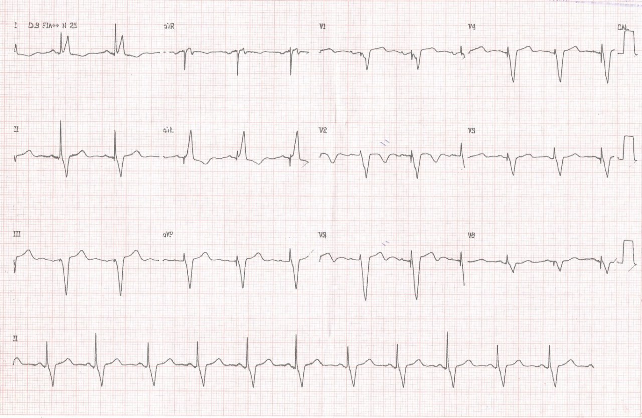 Paciente portador de MCD que presenta dolor precordial con ondas T concordantes negativas durante el ritmo ventricular estimulado, que rememora el comportamiento de la repolarización en la miocardiopatía de Takotsubo