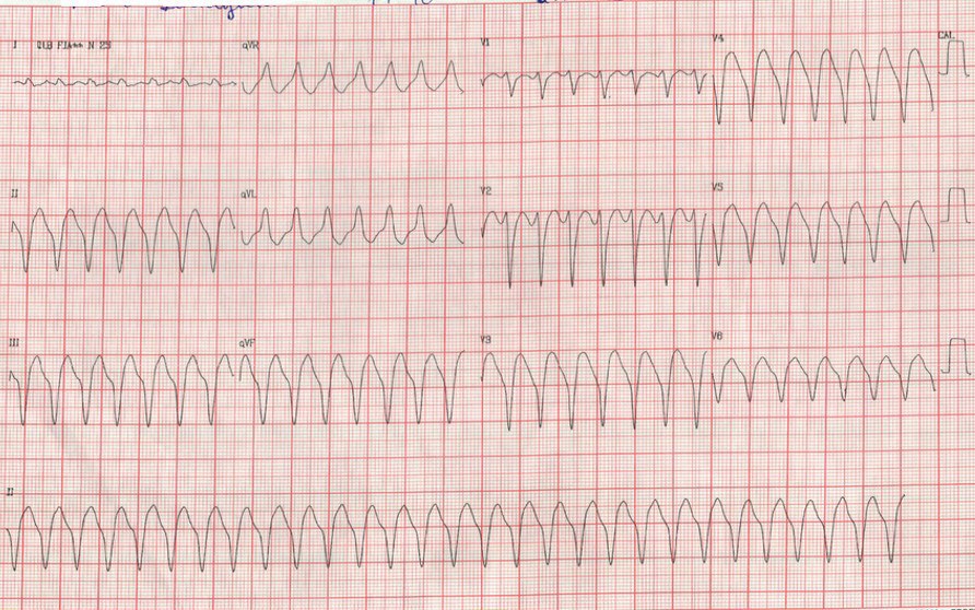Masculino de 74 años con antecedentes de revascularización miocárdica que presenta ángor, náuseas y mareos cuyo ECG muestra TV originada en áreas fibróticas y aneurismática