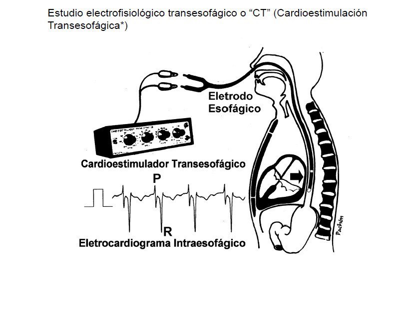 Paciente joven con antecedentes de síncope precedido de palpitaciones. Mediante la aplicación de extraestímulos transesofágicos programados, es posible determinar cuál es el mayor intervalo entre dos estímulos consecutivos, que no es conducido a los ventrículos por el haz anómalo