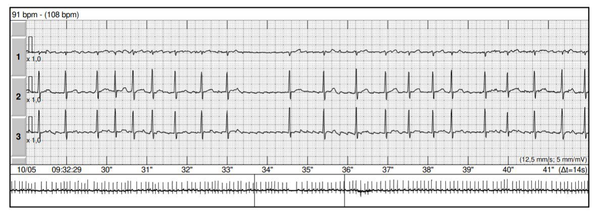 Paciente con fibrilación auricular crónica donde se observa la presencia de fenómeno de Ashman, con aberrancia más común en la rama derecha.