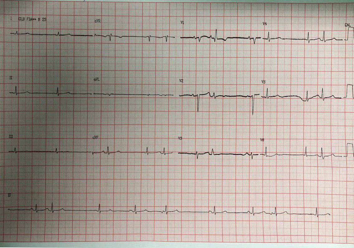 Mujer de 100 años portadora de EPOC que cursa una infeción respiratoria en estudio que presenta ritmo auricular caótico prefibrilatorio relacionado con la hipoxia