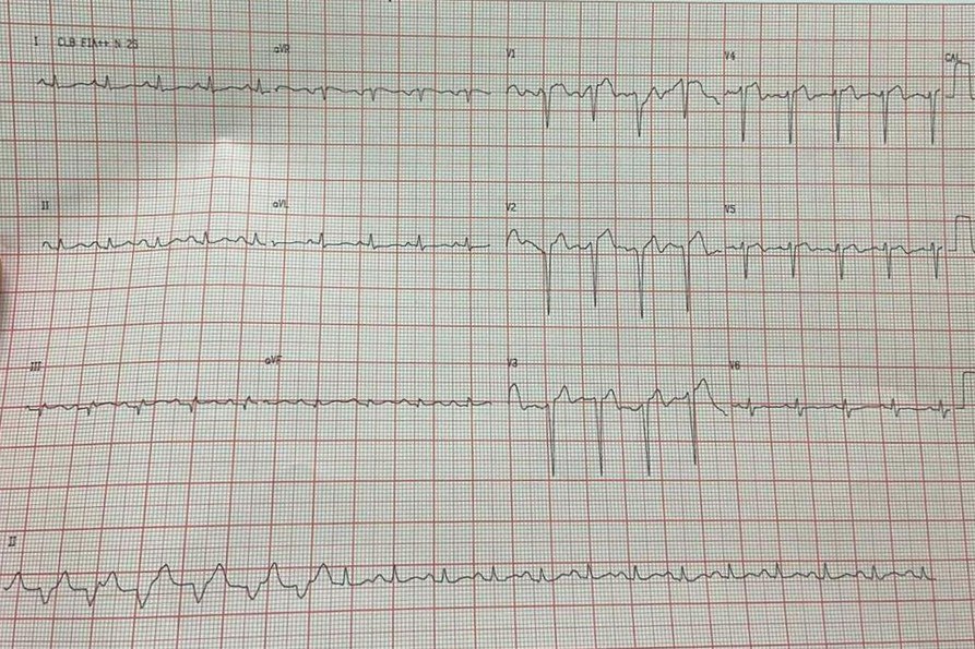 Paciente masculino de 47 años con infarto previo e implante de stent que presentó palpitaciones, constatándose en la CCG oclusión del mismo