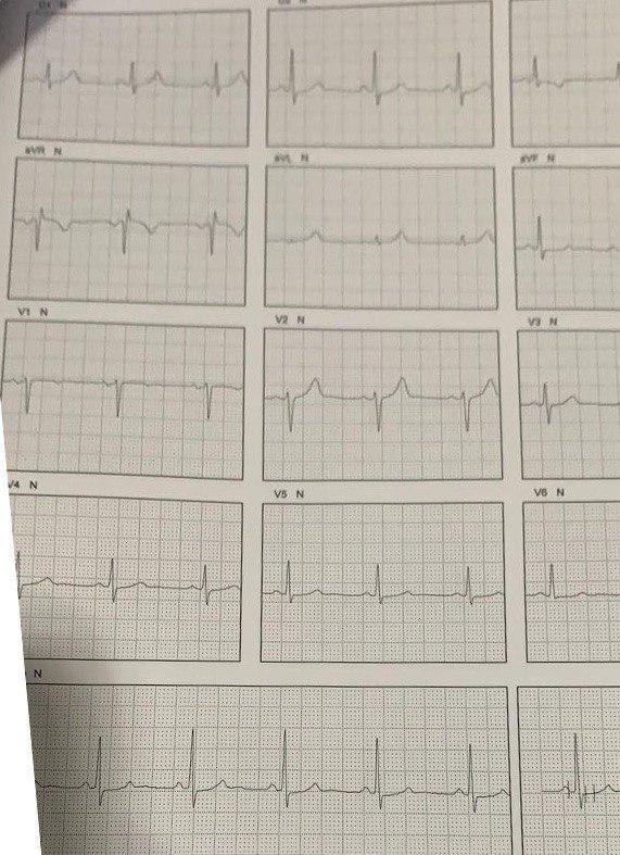 Hombre obeso, dislipémico e hipertenso de 48 años que realiza una PEG de rutina en la que presenta TVNS