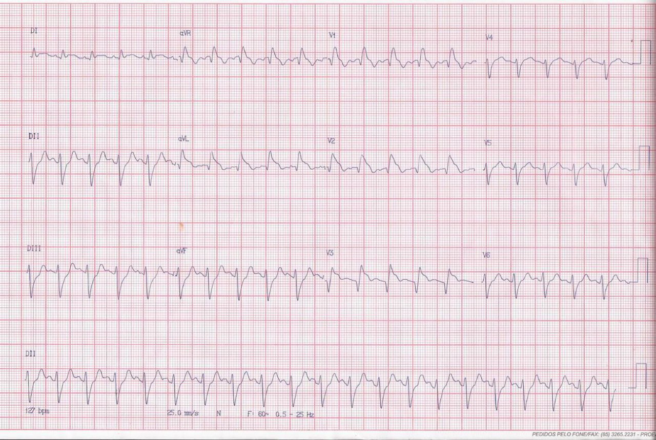 Varón fumador e hipertenso  de 57 años, con dolor torácico opresivo en reposo cuya CCG mostró  trombosis ocluyendo la arteria coronaria DA proximal; Después de la intervención percutánea, el patrón Brugada tipo 1 evolucionó a BRD completo clásico con elevación del segmento ST convexo persistente a través de V1-V2, DI-aVL