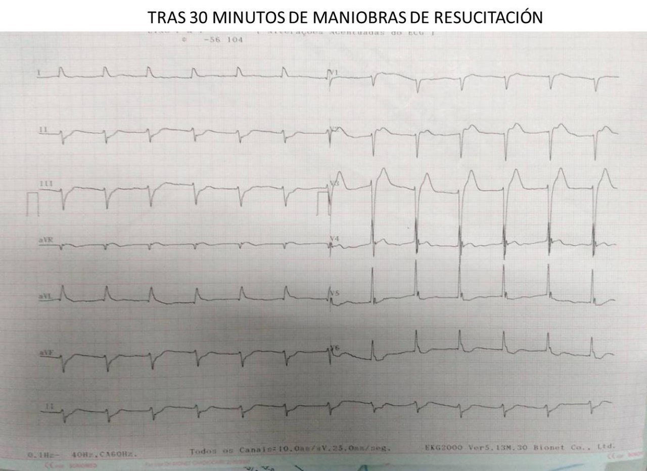 Paciente de 48 años, medicado con bisoprolol 5 mg / día, con antecedentes de respiración agónica y desmayo de 20 minutos que ingresa inconsciente, con FV, cuyo ECG presenta signos de repolarizaciñon precoz y síndrome de Brugada