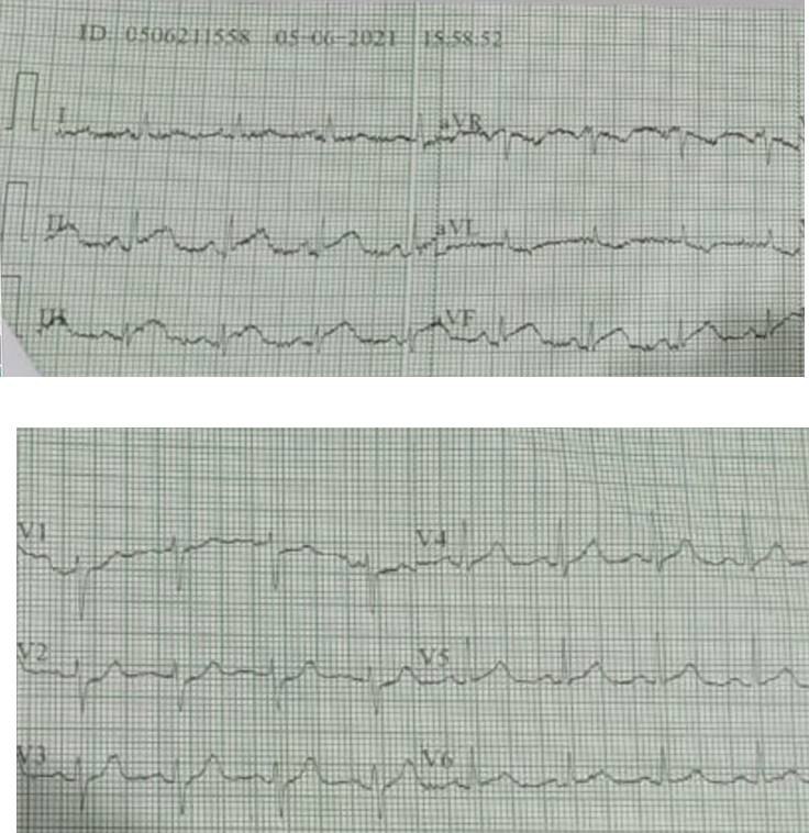 Mujer de 51 años, DBT tipo II e HTA, con dolor precordial opresivo y troponina elevada en cuyo ECG se observa patrón de De Winter y cuya CCG presenta una placa en la Cx con espasmo