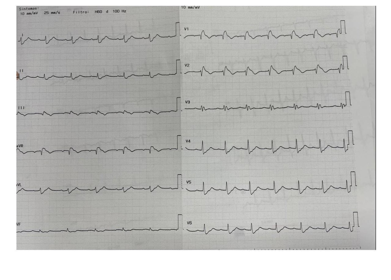 Paciente masculino de 45 años, SRAG por COVID, evoluciona con paro cardiaco  en el momento de la intubación; luego de la reanimación cursa con hiperpirexia e insuficiencia respiratoria hipoxémica