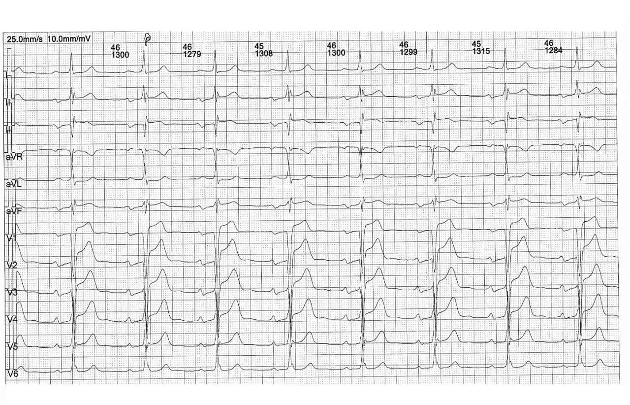 Varón de 70 años con historia previa de ACV isquémico transitorio cuyo estudio vectorcardiográfico en el plano frontal demuestra la activación retrógrada de la auricula izquierda, explicado porque la activación de la aurícula derecha e izquierda poseen sentidos casi opuestos, dada la interrupción a nivel del haz de Bachmann