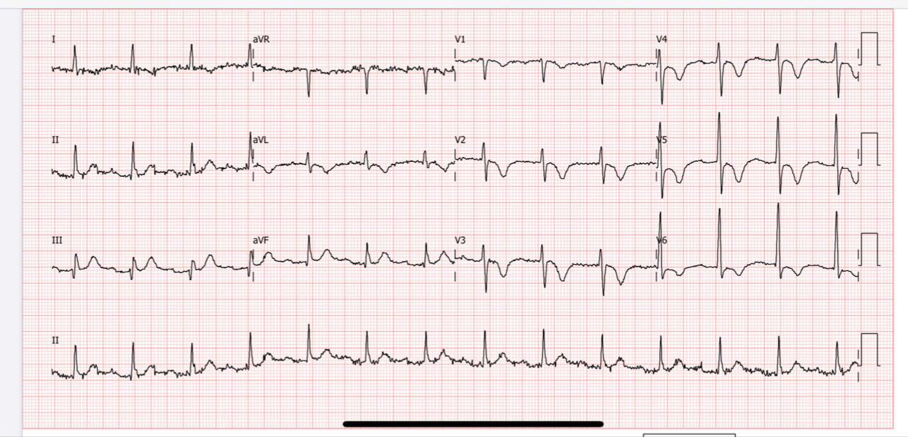 Mujer de 50 años, diabetica y dislipémica que presenta angina predominantemente nocturna, cuadro interpretado como «problema emocional» cuya CCG mostró coronarias normales siendo + a la prueba de vasoespasmo