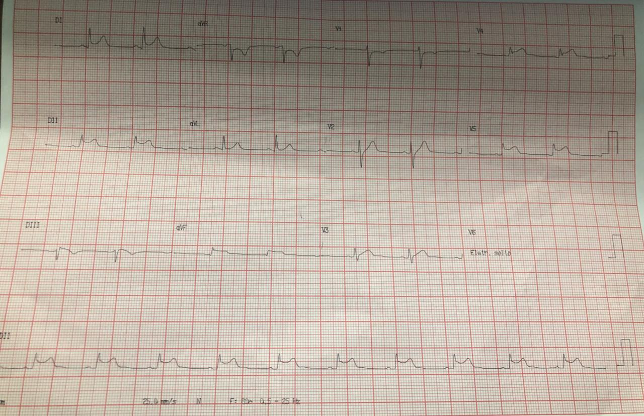 Paciente obesa de 30 años con historia familiar de enfermedad coronaria que consulta por dolor precordial opresivo  irradiado al brazo derecho con troponina de 2600 con CCG normal, compatible con miocarditis
