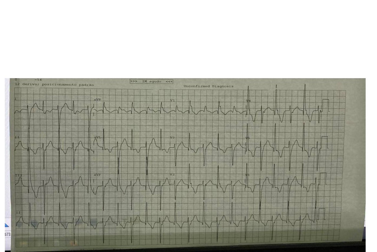 Paciente en el 9no día de ser sometido a un trasplante cardíaco, en uso de múltiples fármacos vasoactivos, incluida la milrinona, con los siguientes valores de ionograma: Mg 2,3 Ca 8,0  K 3,8, que cursa con TV, posiblemente «TV catecolaminérgica bidireccional»  adquirida, inducida por la polifarmacia, cuyo ECG cambia al ser retirada la milrinona