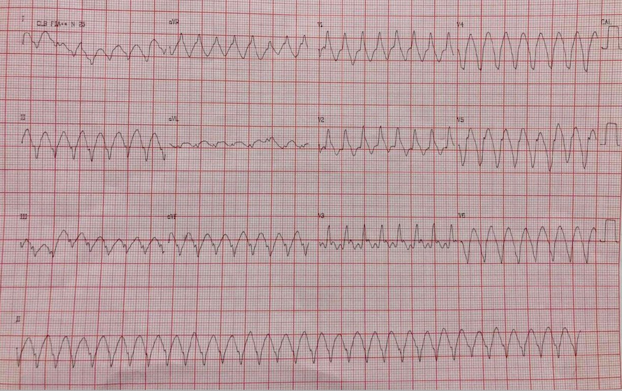 Paciente de 41 años con antececentes de IAM con implante de stent en 2019 , que al levantarse presenta visión borrosa, evolucionando a síncope. Al despertar refiere ángor típico; desde entonces presenta disnea de esfuerzo y patrón qR en V3, constatándose TV por lo que es tratado con CVE y amiodarona y hallazgo de  DA con reestenosis intra-stent (80%) » ATC con 2 stents. TIMI 3
