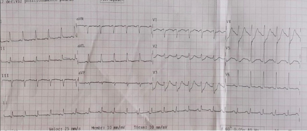 Paciente masculino de 62 años, con ángor y disnea en reposo durante 4 horas con presencia de patrón de Winter, con demora en la toma de decisiones que evoluciona al óbito