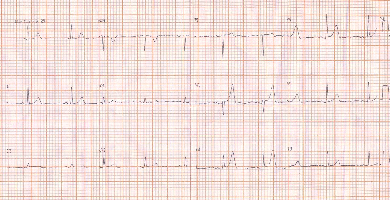 Paciente que ingresó con un síndrome coronario agudo, sin que se tomen medidas inmediatas no obstante lo cuál tiene bueba evolución las primeras 24 hs cuando se realiza CCG que constata DA subocluída y presencia de trombo con reperfusión incompleta espontánea