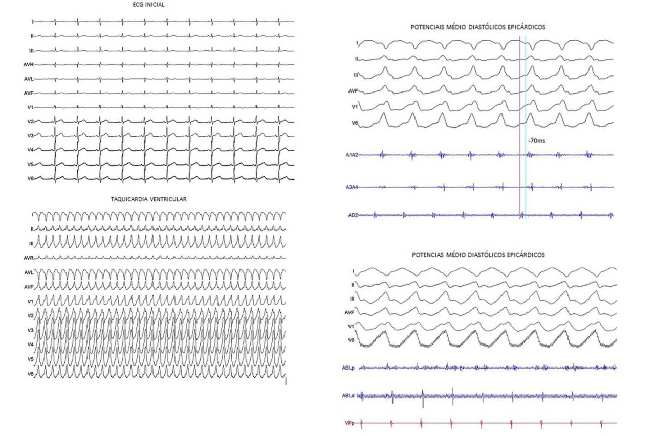 Paciente portador de cardiopatía chagásica y tormentas eléctricas que determinan descargas de CDI, por cicatriz epicárdica posterolateral basal que se somete a ablación exitosa asociada a simpatectomía renal