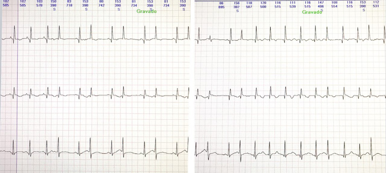 Holter  de una mujer  de 68 años que ingresa por COVID-19 presentando ESV bigeminadas y AA con hipocinecia difusa severa en el eco. haciendo sugestivo el diagnóstico de miocarditis por COVID