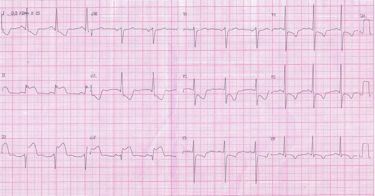Paciente cursando SCA con CCG que muestra lesiones en CD y Cx con circulación colateral a ésta última, lo que pone de manifiesto que la arteria culpable es le CD