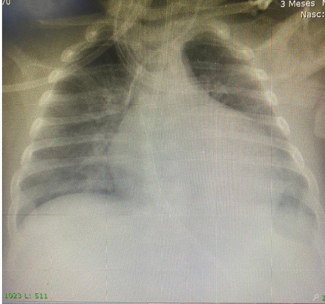 Niño de 4 años que consulta por «gripe» en cuyo ECG se observan ondas Q muy profundas en las derivadas izquierdas DI y  aVL