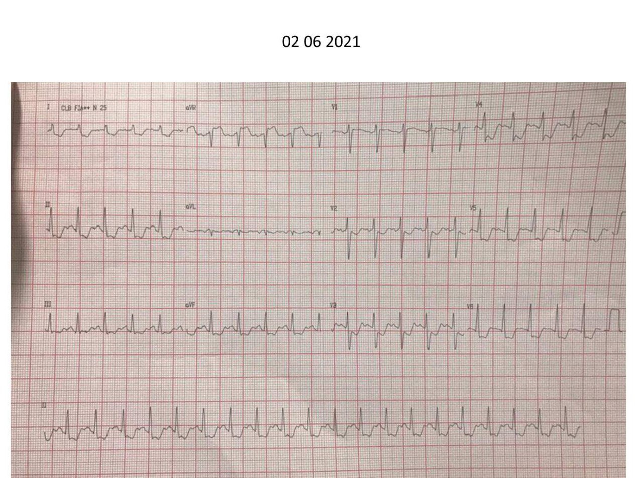Mujer 44 años en plan de cirugía previa para el reemplazo de la válvula mitral que presenta dolor precordial opresivo. Tiene antecedente de episodio previo en el que se constató espasmo del TCI, por lo cuál se realizará nueva CCG con ecografía intracoronaria