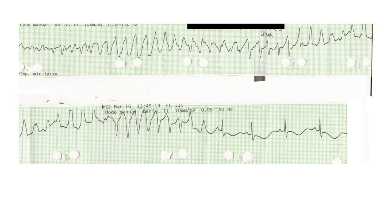 Paciente masculino de 34 años que fue admitido por presentar una TV polimórfica con antecedentes recientes de palpitaciones recurrentes y síncopes, portador de SQTL congénito a quién erróneamente se indica amiodarona