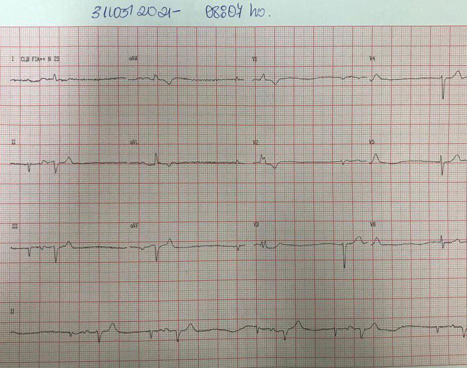 Paciente de 77 años con antecedentes de ACV, tratado con amiodarona y rivaroxaban, con disnea y dolor precordial progresivos en la última semana, que presenta bigeminismo de escape-captura seguido de ritmo de escape de la unión, que pone de manifiesto un grave compromsio del nódulo sinusal
