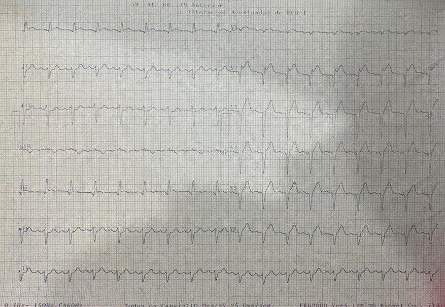 Hombre 56 años, DBT, con cardiopatía previa con antecedente de implante de stent, con dolor torácico con irradiación a la espalda y sudoración intensa