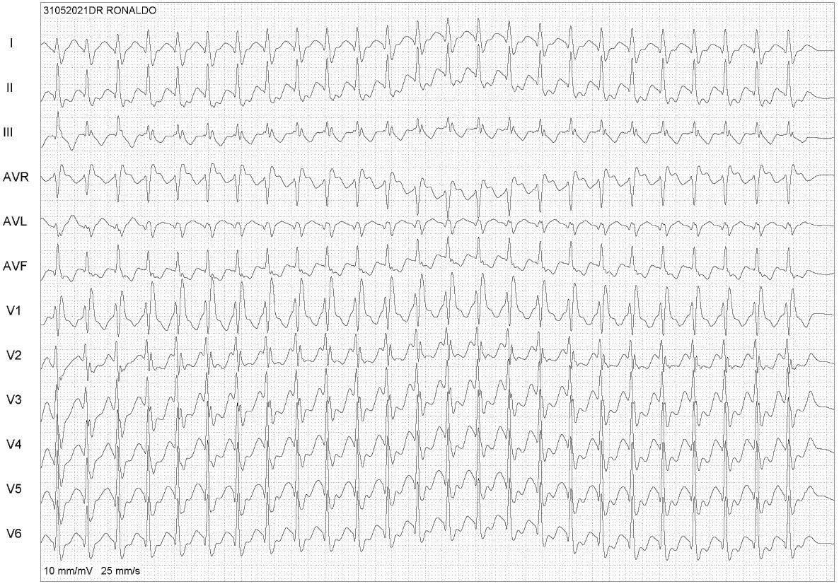 Paciente con antecedente de palpitaciones recurrentes y registro de taquicardia regular con QRS ancho con imagen de BRI. El ECG basal muestra un patrón de BIRD; en EEF se constata Taquicardia por reentrada AV con aberrancia inicial con un patrón similar al de la arritmia clínica por presencia de haz accesorio posteroseptal izquierdo