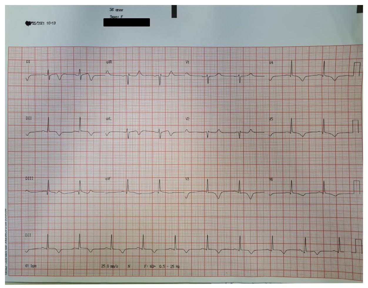 Mujer de 56 años, hospitalizada  por forma grave de COVID 19, con troponima elevada que se interpreta como síndrome de takotsubo
