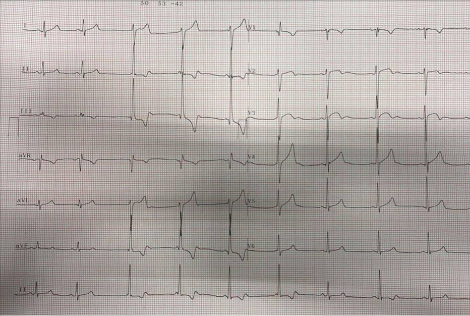 Niño de 13 años asintomático que es evaluado para práctica deportiva cuyo ECG presenta disociación AV por interferencia y RIVA