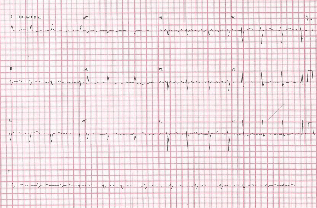 Mujer de 59 años portadora de miocardio no compactado biventricular que recibe transplante cardíaco exitoso