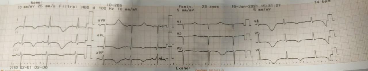 Mujer de 23 años que presenta miocardiopatía periparto, actualmente asintomática con tratamiento de IC que presenta SQTL congénito