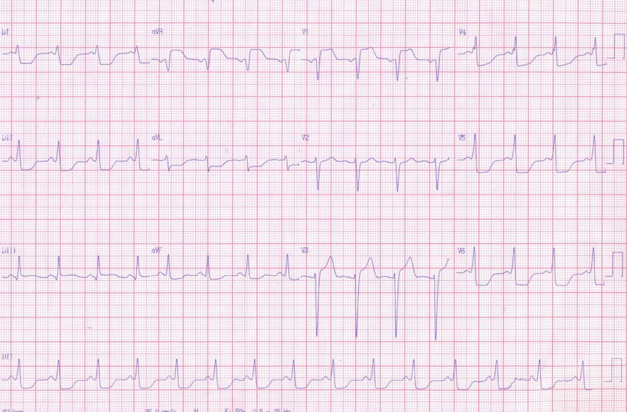 Varón de 60 años con historia de angina desde hace 3 meses que se hace progresivo, con episodios en reposo, ingresando con una taquicardia de QRS ancho (vista en el monitor) e inestabilidad hemodinámica, requiriendo CVE, en quién se constata oclusión ostial del TCI (90%); CD con oclusión proximal 100%; Cx sin lesiones y presencia de circulación colateral grado III a la arteria coronaria derecha. implantándose stent en el TCI
