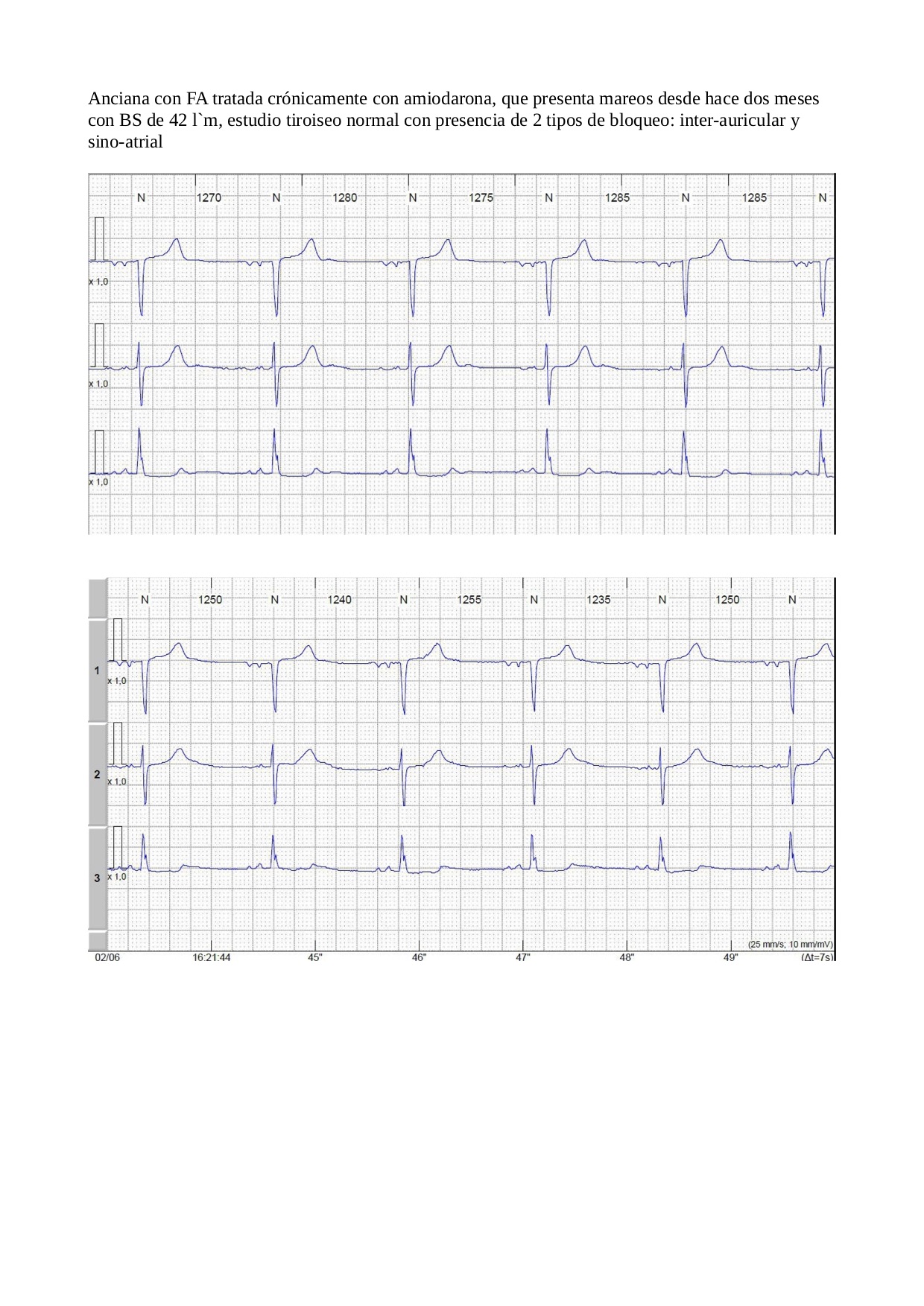Anciana con FA tratada crónicamente con amiodarona, que presenta mareos desde hace dos meses con BS de 42 lpm, estudio tiroideo normal con presencia de 2 tipos de bloqueo: inter-auricular y sino-atrial