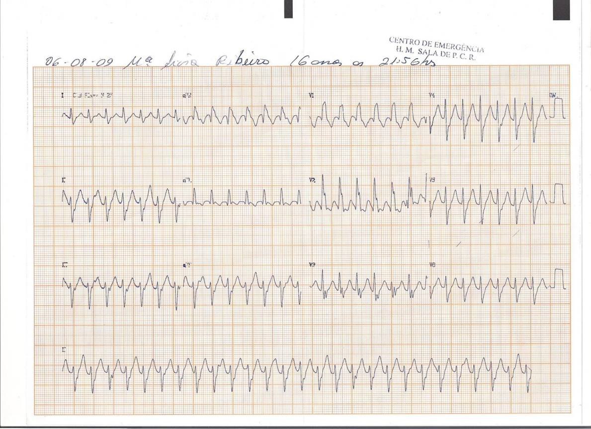 Mujer de 16 años que presenta una Taquicardia ventricular de Belhassen, (taquicardia ventricular sensible al verapamilo)
