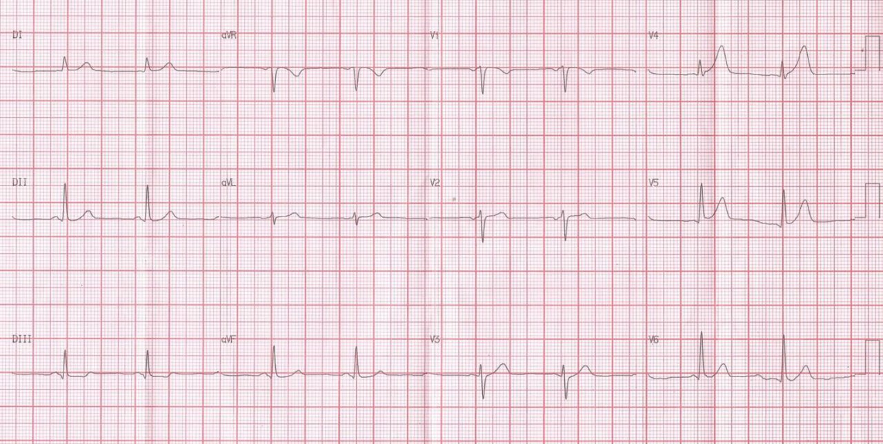 Mujer de 59 años que consulta por episodio anginoso que cursa con ECG que es interpretado como normal y troponina normal siendo dada de alta. A los 4 días, el dolor volvió con mayor intensidad y duración, por lo que se realiza CCG que constata oclusión de DA por trombo realizándose PCI exitosa aunque el ECG post procedimiento mostraba ST elevado en DI, aVL y V2; se reitera CCG que muestra Dg sub-ocluída con trombo que probablemente fue completamente ocluída posteriormente.
