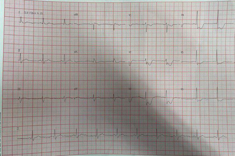Paciente masculino de 49 años con dolor toráccico «desgarrante» que se reitera por compromiso de TCI, con desarrollo de shock cardiogénico y evolución al óbito