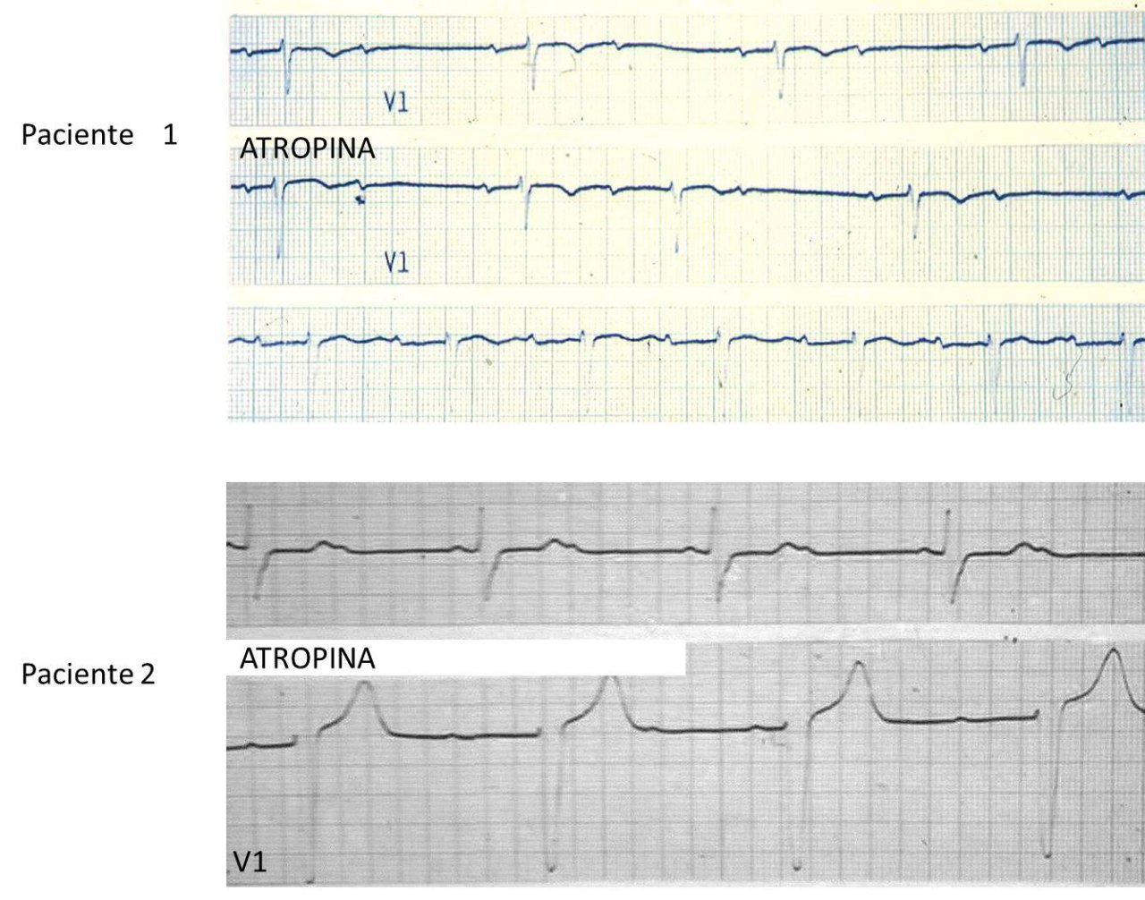2 pacientes tienen BAV 2: 1. Paciente 1 con localización supra-His y paciente 2 con localización infra-His: el paciente dos desarrolla BAVC y tiene inficacaión de MP