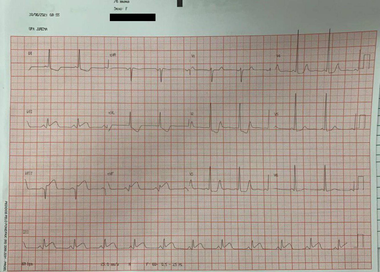 Mujer de 76 años con dolor precordial opresivo  y vómitos con una vía accesoria enmascarada por IAM, por CD subocluída proximal y ocluída totalmente distal