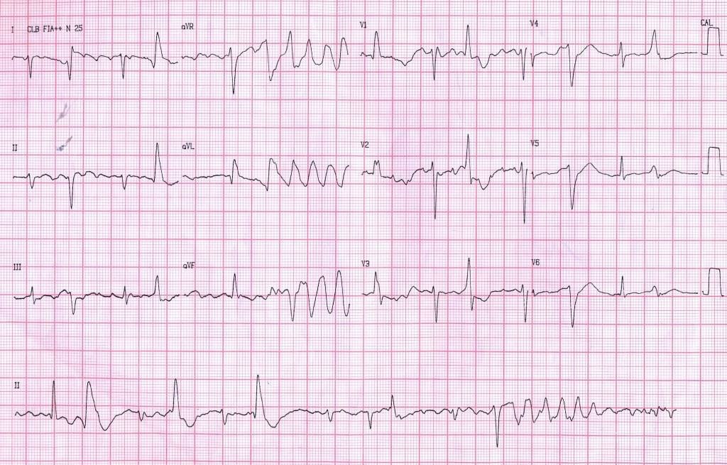 Mujer de 78 años en tratamiento con diurético & warfarina que presenta síncopes a repetición tras un tratamiento con moxifloxacina que es tratada con sulfato de magnesio IV y K desapareciendo las Torsades des Pointes.