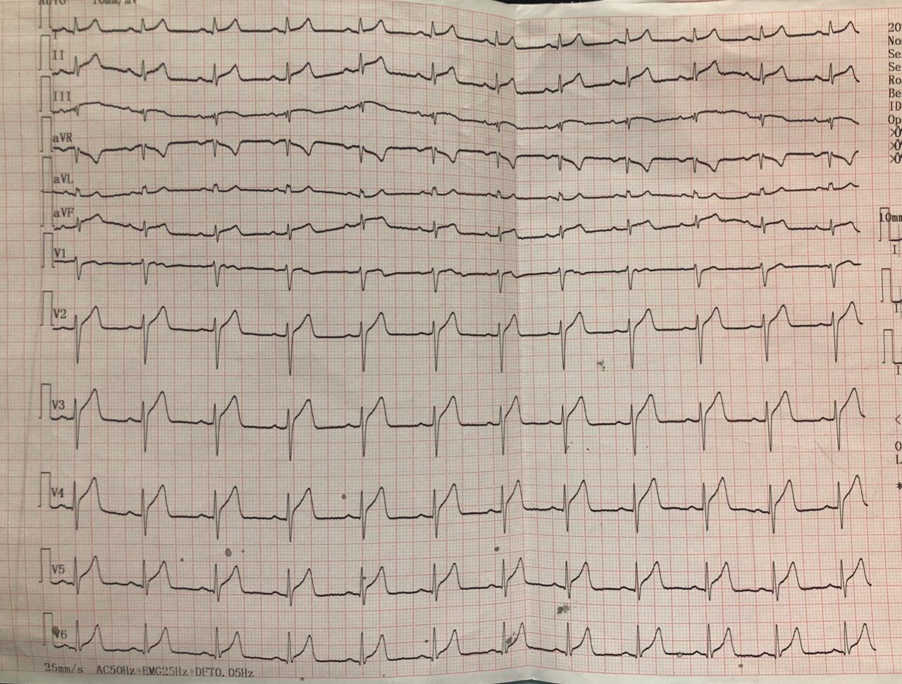 Hombre de 30 años, consumidor de cocaína que presenta dolor de pecho reentrante / atípico que llegó al hospital sin dolor cuya CCG mostró Imagen de trombo en la DA  (1/3 proximal y distal) con embolización distal