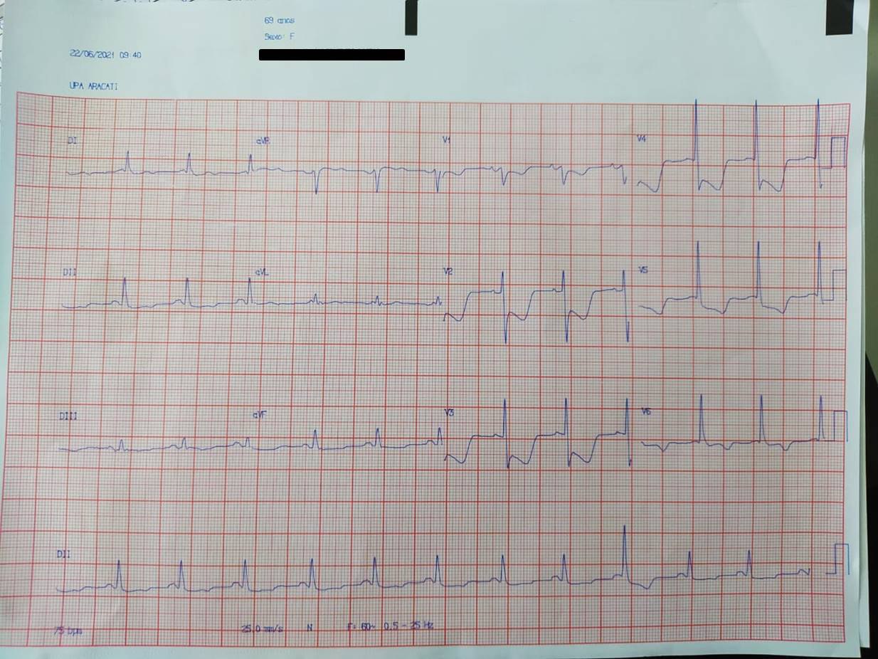 Mujer de 69 años que presenta epigastralgia, síntomas neurovegetativos y desarrolla episodio sincopal en contexto de SCA