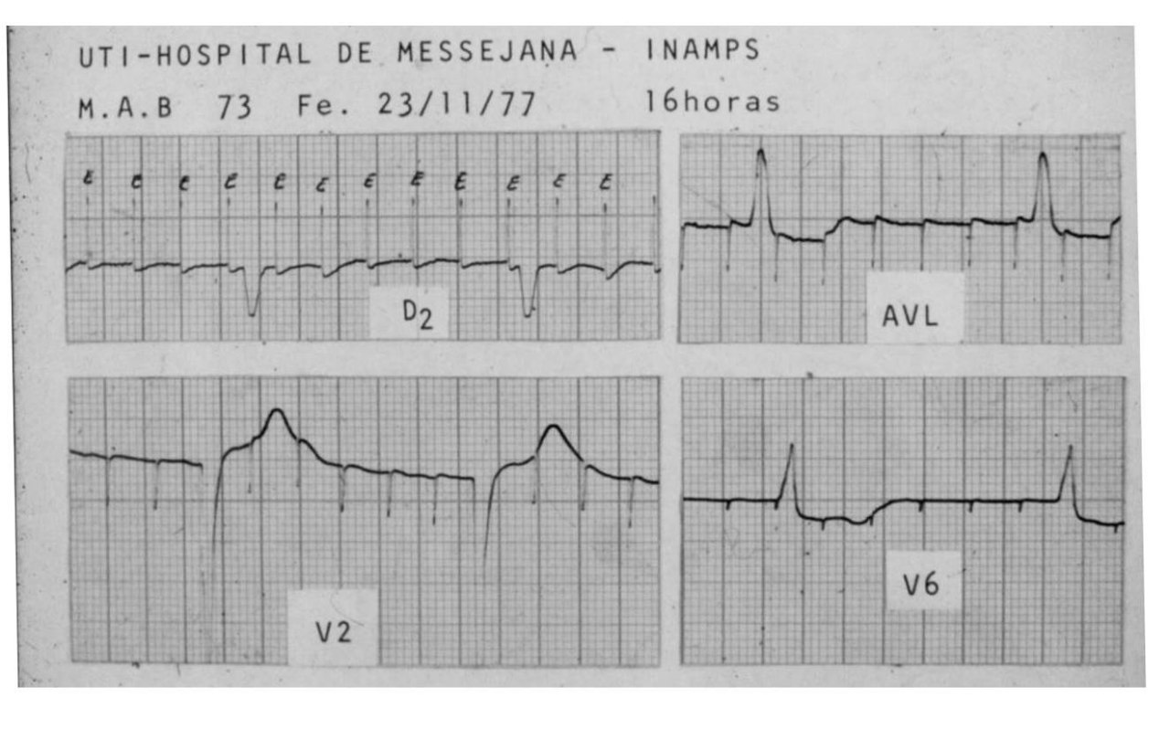 Paciente de 73 años portador de MP VVI implantado por BAVC que ingresa por episodios sincopales por runaway pacemaker por agotamiento de la batería