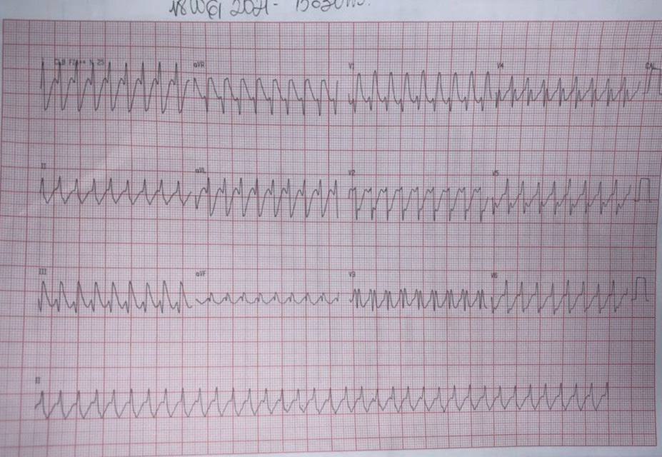 ECGs actual, de 2020 y 2019 de paciente con taquicardia a 300lpm por TRAVO con bloqueo ipsilateral