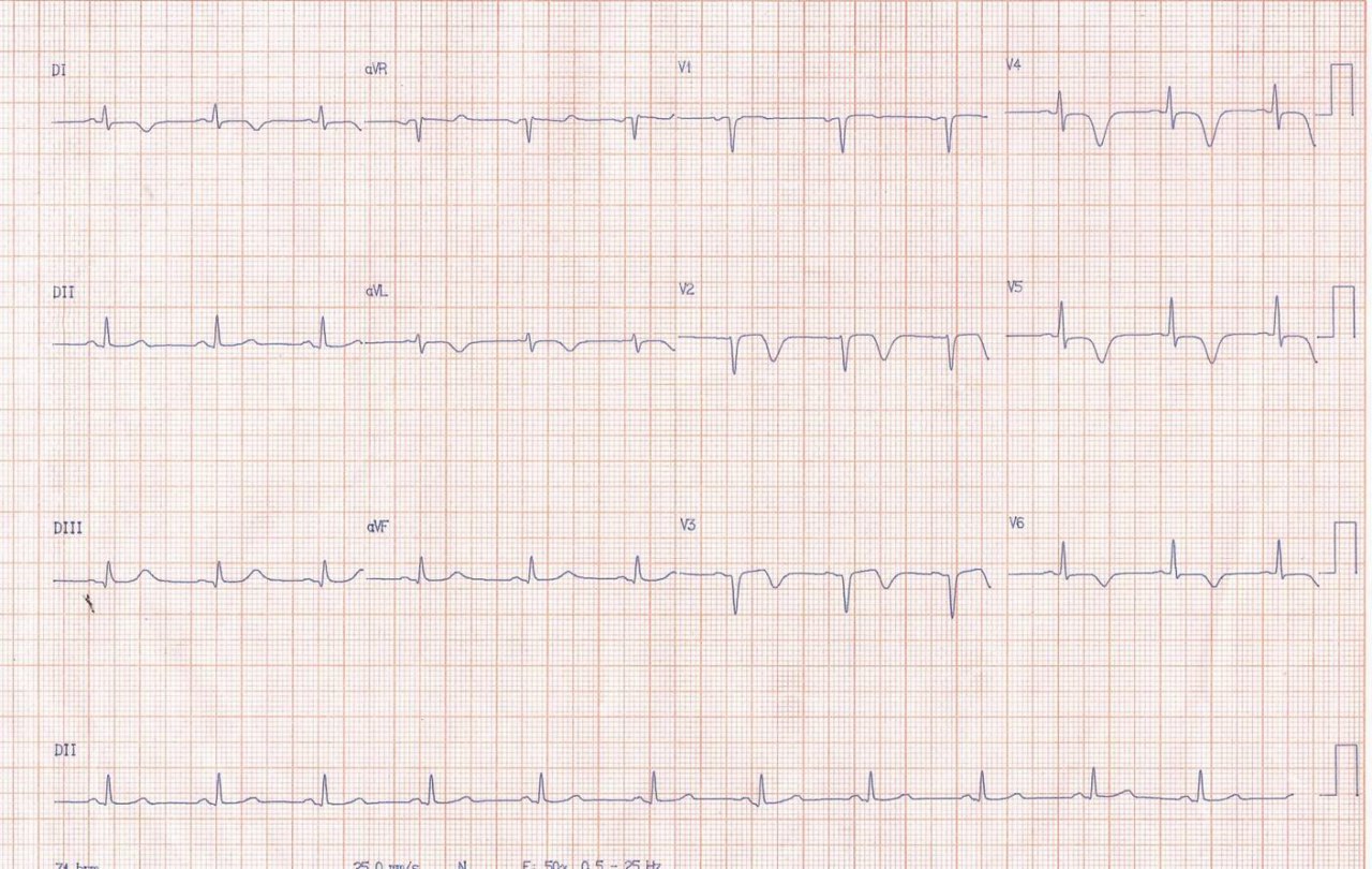 Mujer de 35 años acude a urgencias por dolor precordial opresivo > 20 min con alivio después de usar nitrato sublingual.
