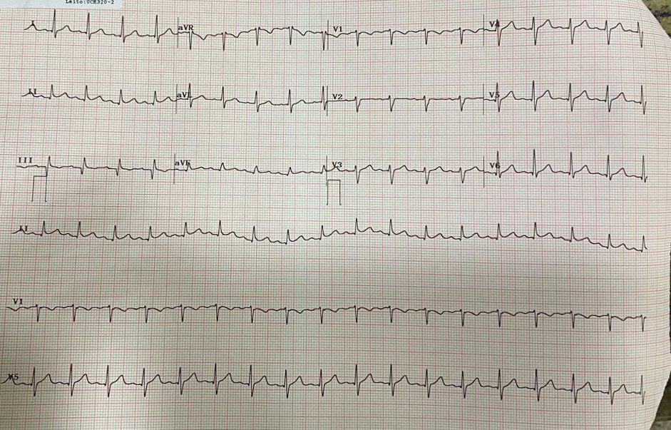 Paciente de 19 años cursando COVID 19 que presenta disnea repentina con hipoxemia siendo intubado, cuyo ECG es sugestivo de embolia de pulmón